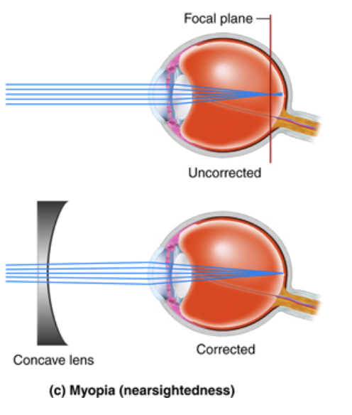 Myopia Diagram